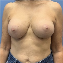 Breast Implant Revision After Photo by Alexis Parcells, MD; Eatontown, NJ - Case 47022
