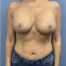 Breast Implant Revision After Photo by Alexis Parcells, MD; Eatontown, NJ - Case 47024