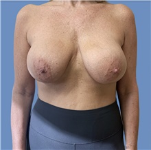 Breast Implant Revision Before Photo by Alexis Parcells, MD; Eatontown, NJ - Case 47024