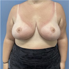 Breast Reduction After Photo by Alexis Parcells, MD; Eatontown, NJ - Case 47026