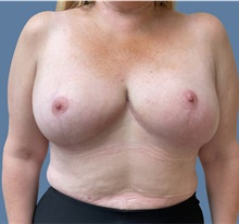 Breast Reduction After Photo by Alexis Parcells, MD; Eatontown, NJ - Case 47027