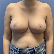 Breast Reduction After Photo by Alexis Parcells, MD; Eatontown, NJ - Case 47028