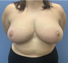 Breast Reduction After Photo by Alexis Parcells, MD; Eatontown, NJ - Case 47029