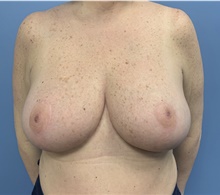 Breast Reduction After Photo by Alexis Parcells, MD; Eatontown, NJ - Case 47030