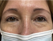 Eyelid Surgery After Photo by Alexis Parcells, MD; Eatontown, NJ - Case 47039