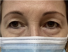 Eyelid Surgery Before Photo by Alexis Parcells, MD; Eatontown, NJ - Case 47039