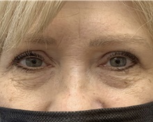 Eyelid Surgery After Photo by Alexis Parcells, MD; Eatontown, NJ - Case 47043