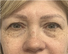 Eyelid Surgery Before Photo by Alexis Parcells, MD; Eatontown, NJ - Case 47043