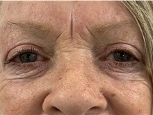 Eyelid Surgery After Photo by Alexis Parcells, MD; Eatontown, NJ - Case 47044