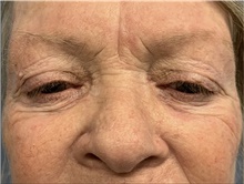 Eyelid Surgery Before Photo by Alexis Parcells, MD; Eatontown, NJ - Case 47044
