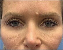 Eyelid Surgery Before Photo by Alexis Parcells, MD; Eatontown, NJ - Case 47045