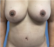 Tummy Tuck After Photo by Alexis Parcells, MD; Eatontown, NJ - Case 47046