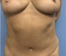 Tummy Tuck After Photo by Alexis Parcells, MD; Eatontown, NJ - Case 47047