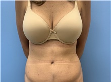Tummy Tuck After Photo by Alexis Parcells, MD; Eatontown, NJ - Case 47048