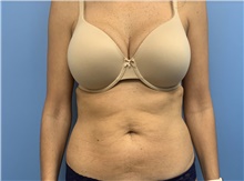Tummy Tuck Before Photo by Alexis Parcells, MD; Eatontown, NJ - Case 47048