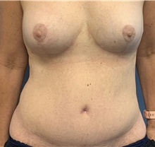 Tummy Tuck After Photo by Alexis Parcells, MD; Eatontown, NJ - Case 47049