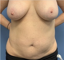 Tummy Tuck Before Photo by Alexis Parcells, MD; Eatontown, NJ - Case 47049