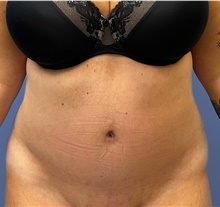 Tummy Tuck After Photo by Alexis Parcells, MD; Eatontown, NJ - Case 47050