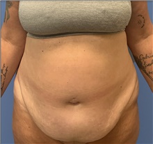 Tummy Tuck Before Photo by Alexis Parcells, MD; Eatontown, NJ - Case 47050