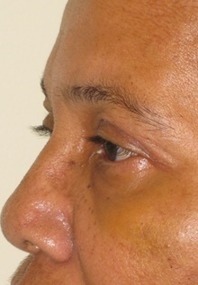 Eyelid Surgery After Photo by Mark McRae, MD, FRCS(C); Burlington, ON - Case 38914