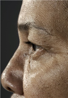 Eyelid Surgery Before Photo by Mark McRae, MD, FRCS(C); Burlington, ON - Case 38914