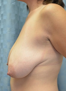 Breast Reconstruction Before Photo by Mark McRae, MD, FRCS(C); Hamilton, ON - Case 39213