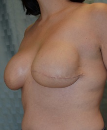 Breast Reconstruction After Photo by Mark McRae, MD, FRCS(C); Hamilton, ON - Case 39213