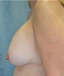 Breast Implant Removal Before Photo by Mark McRae, MD, FRCS(C); Burlington, ON - Case 39218