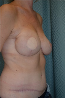 Breast Reconstruction After Photo by Mark McRae, MD, FRCS(C); Hamilton, ON - Case 39219