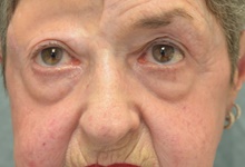 Eyelid Surgery Before Photo by Mark McRae, MD, FRCS(C); Burlington, ON - Case 41452