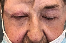 Eyelid Surgery After Photo by Mark McRae, MD, FRCS(C); Burlington, ON - Case 41452