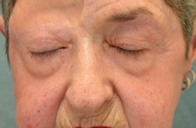 Eyelid Surgery Before Photo by Mark McRae, MD, FRCS(C); Burlington, ON - Case 41452