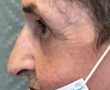 Eyelid Surgery After Photo by Mark McRae, MD, FRCS(C); Burlington, ON - Case 41452