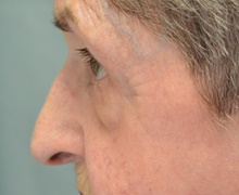 Eyelid Surgery Before Photo by Mark McRae, MD, FRCS(C); Burlington, ON - Case 41452