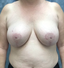 Breast Implant Revision After Photo by Mark McRae, MD, FRCS(C); Burlington, ON - Case 41453