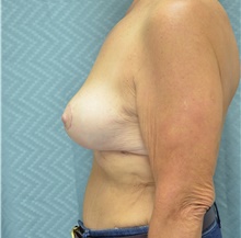 Breast Lift After Photo by Mark McRae, MD, FRCS(C); Burlington, ON - Case 41518