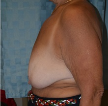 Breast Lift Before Photo by Mark McRae, MD, FRCS(C); Burlington, ON - Case 41518