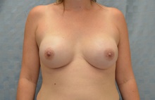 Breast Reconstruction After Photo by Mark McRae, MD, FRCS(C); Hamilton, ON - Case 41686