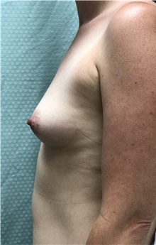 Breast Reconstruction Before Photo by Mark McRae, MD, FRCS(C); Burlington, ON - Case 41686