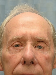 Eyelid Surgery After Photo by Mark McRae, MD, FRCS(C); Burlington, ON - Case 42013
