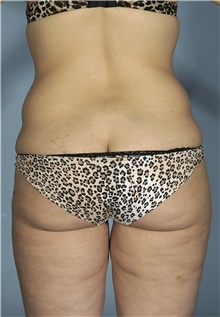 Liposuction Before Photo by Mark McRae, MD, FRCS(C); Burlington, ON - Case 42022