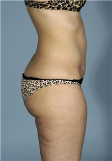 Liposuction Before Photo by Mark McRae, MD, FRCS(C); Burlington, ON - Case 42022