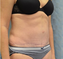 Tummy Tuck After Photo by Mark McRae, MD, FRCS(C); Burlington, ON - Case 42023