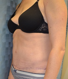 Tummy Tuck After Photo by Mark McRae, MD, FRCS(C); Burlington, ON - Case 42023