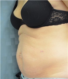 Tummy Tuck Before Photo by Mark McRae, MD, FRCS(C); Burlington, ON - Case 42023