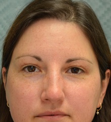 Eyelid Surgery After Photo by Mark McRae, MD, FRCS(C); Hamilton, ON - Case 43124