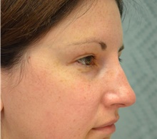 Eyelid Surgery After Photo by Mark McRae, MD, FRCS(C); Hamilton, ON - Case 43124