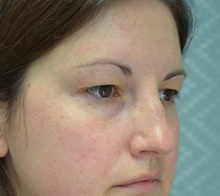 Eyelid Surgery Before Photo by Mark McRae, MD, FRCS(C); Hamilton, ON - Case 43124