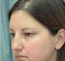 Eyelid Surgery Before Photo by Mark McRae, MD, FRCS(C); Hamilton, ON - Case 43124