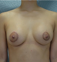 Breast Augmentation After Photo by Mark McRae, MD, FRCS(C); Burlington, ON - Case 44331